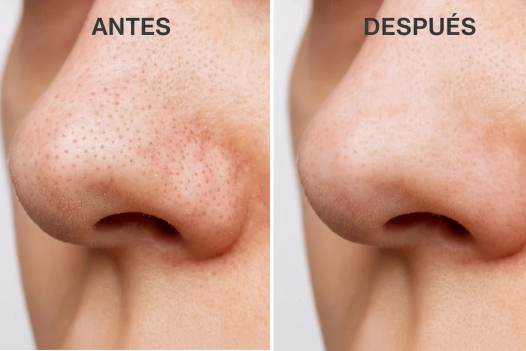 Limpiador Facial Ultrasónico - LA ROSÉ